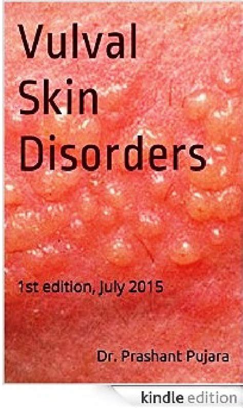 Vulval Skin Disorders By Dr Prashant Pujara Issuu