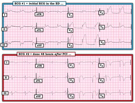 Dr Smith S Ecg Blog Co Poisoning Routine Ecg Recorded Before