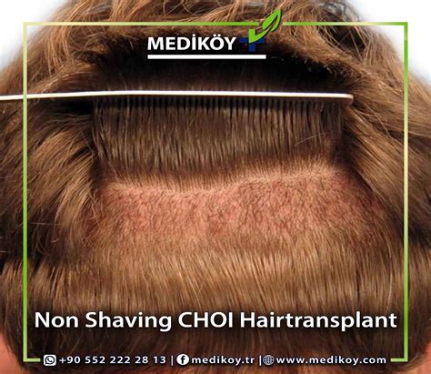 FEMALE HAIR TRANSPLANT BE DONE WITHOUT SHAVING THE HEIR Best Hair