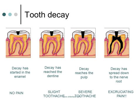 painful tooth no decay