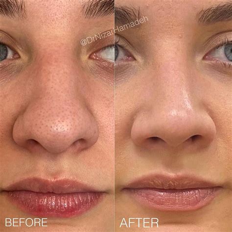 Nose Job Bulbous Tip Before And After Bulbousnose