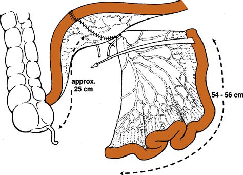 Nerve Sparing Radical Cystectomy And Orthotopic Bladder Replacement In