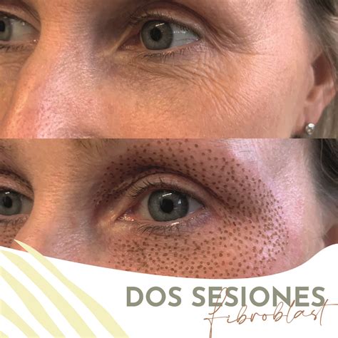 Dos Sesiones Fibroblast O Plasma Pen Contorno De Ojos Zafi Estetica