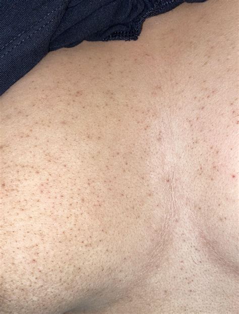 KP ON CHEST IS GETTING WORSE I Have Tried Everything R Keratosis