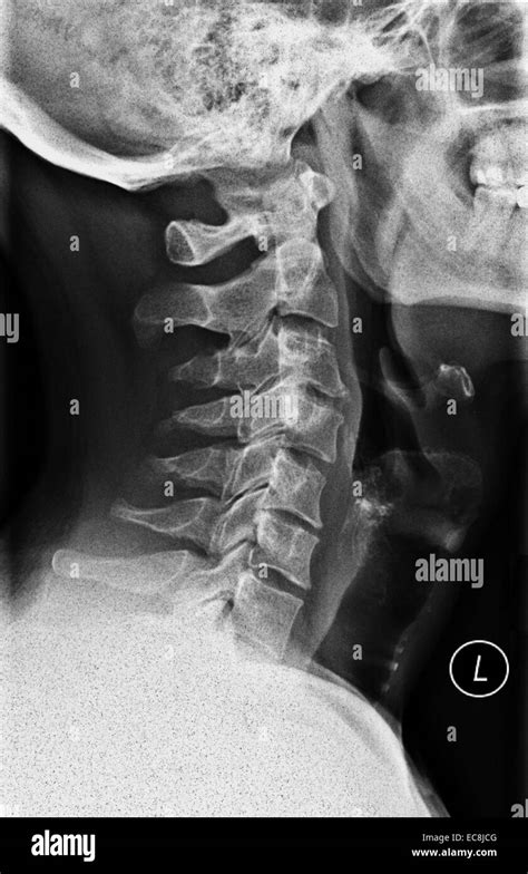 Radiografia Laterale Immagini E Fotografie Stock Ad Alta Risoluzione