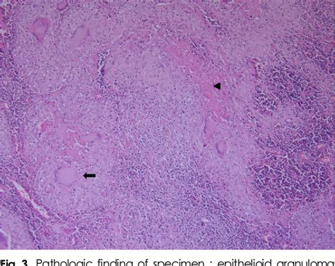 Figure 3 From A Case Of Parotid Tuberculosis Mimicking Benign Tumor Of