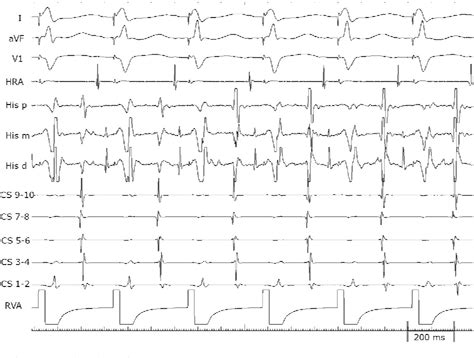 Figure 1 From Ventricular Overdrive Pacing During Supraventricular Tachycardia Semantic Scholar