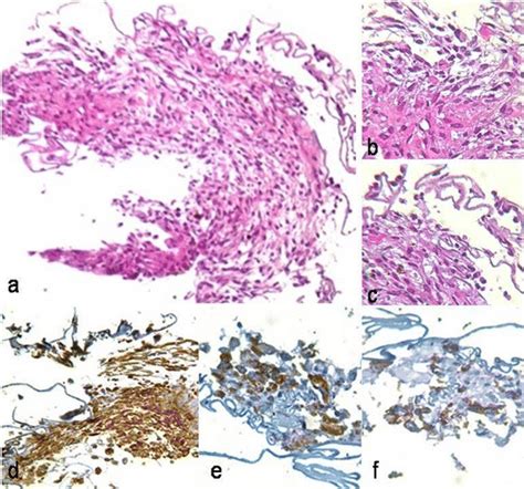 Case 3 Histopathology Of Excised Epiretinal Membrane Hematoxylin And