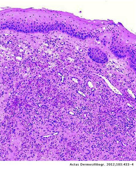 Sessile Nodule On The Gingival Mucosa Actas Dermo Sifiliográficas