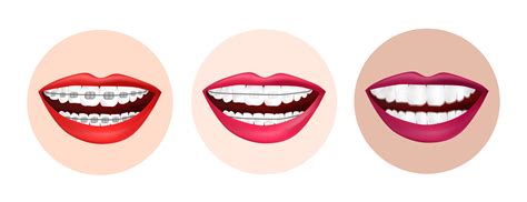 Aligners Vs Braces What Dentists Should Know Orthosnap Blog