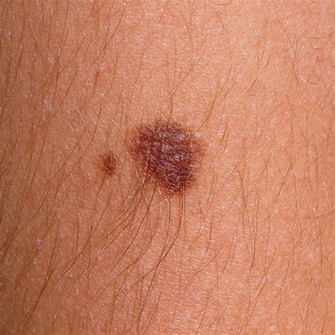 Signs Of Melanoma Mens Health