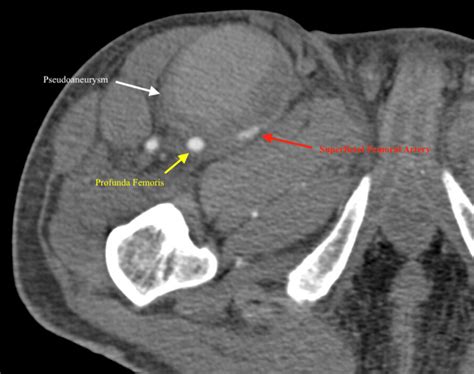 Computed tomography angiogram showing pseudoaneurysm, superficial... | Download Scientific Diagram