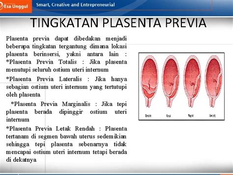 Askep Ruptur Uteri Dan Askep Plasenta Previa Pertemuan