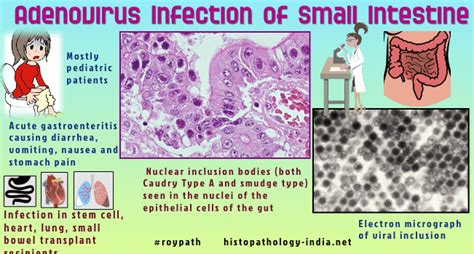 Pathology Of Adenovirus Infection Dr Sampurna Roy Md