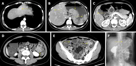 malignant tumors   peutz jeghers syndrome  cases