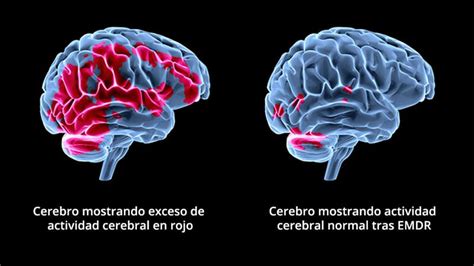 Qué es EMDR Los 8 pasos de la técnica EMDR