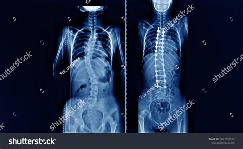 X Ray Spine Screws 826 Images Photos Et Images Vectorielles De Stock