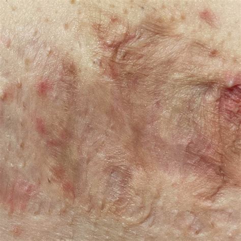 Hidradenitis Suppurativa Van Schuppen Huid En Lasertherapie Sneek