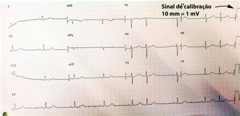 Frequ Ncia Card Aca E Amplitude Como Determinar No Ecg Angomed News