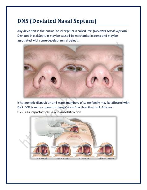 Dns (Deviated Nasal Septum) | SurgicoMed.com