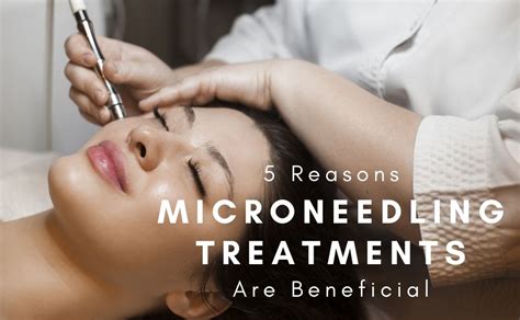 Reasons Microneedling Treatments Are Beneficial