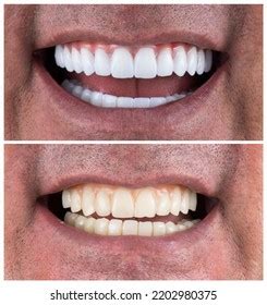 Dental Job Photography Crowns Veneers Implants Stock Photo 2202980375