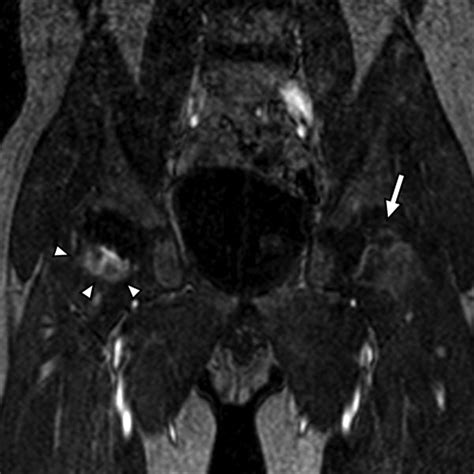MRI of Legg-Calvé-Perthes Disease | AJR