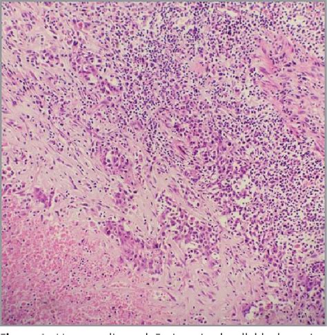 Figure From Lymphoepithelioma Like Carcinoma Of The Lung A Rare Case