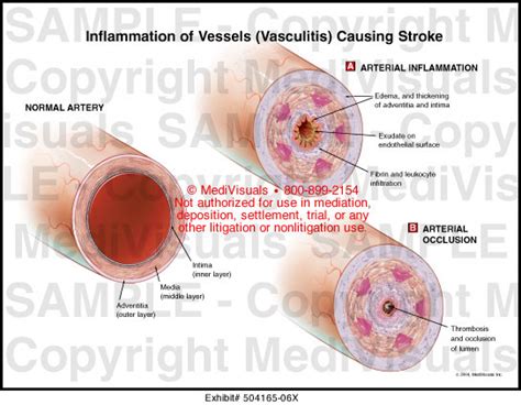 Inflammation Of Vessels Vasculitis Causing Stroke Medical Illustration