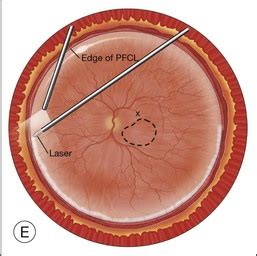 Macular Translocation Ento Key