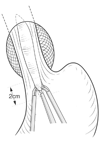 Laparoscopic Heller myotomy (LHM). | Download Scientific Diagram