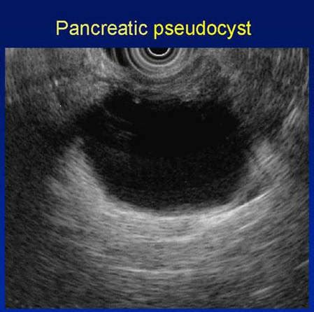 Medical Center: Pancreatic Pseudocyst