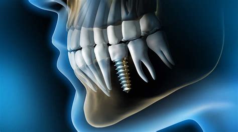 İmplant - Dentram Diş Klinikleri