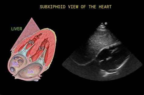 Heart Ultrasound Images - Cardiac ultrasound is also referred to as ...