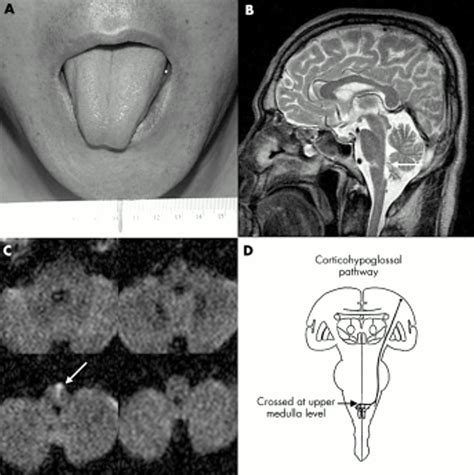 Medial Medullary Infarction With Contralateral Glossoplegia Journal