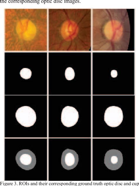 Figure From Optic Disc And Cup Segmentation For Glaucoma