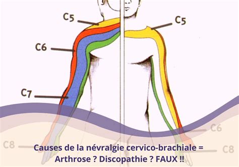 Causes de la névralgie cervico brachiale arthrose discopathie