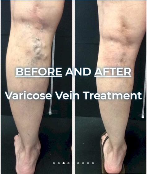 Varicose Veins - Disorders & Procedures - Vein Specialists of the Carolinas