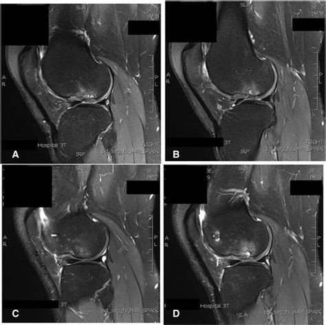 Large Osteochondral Lesions Of The Femoral Condyles Treatment With