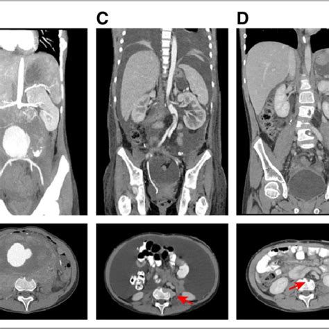 Surgical Resection Of Retroperitoneal Sarcoma A Retroperitoneal