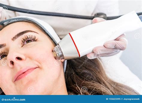 Radio Frequency Microneedling Machine Handpiece On The Cheek Of A Woman`s Face During A Beauty