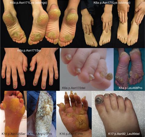 Clinical Features Of Pachyonychia Congenita PC Plantar Keratoderma