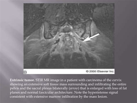 Plexopathy