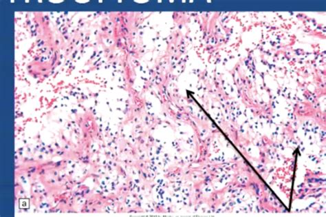 Neoplasms Of The Central Nervous System Flashcards Quizlet