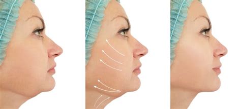 What You Should Know About Double Chin Liposuction Latest Health Facts