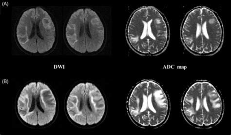 Adc Maps And Dwi At The First And Second Examinations Open I