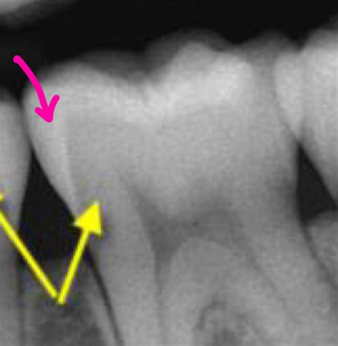 Radiographic Appearance Of Intraoral Anatomy Normal Anatomy