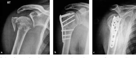 Proximal Humerus Fracture Plate