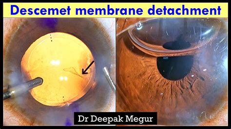 Small Descemet Membrane Detachment At The Side Port Region Dmd Dr