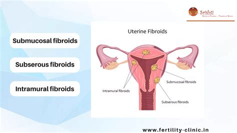 Laparoscopic Myomectomy In Puducherry Fibroids Treatment In Tamil